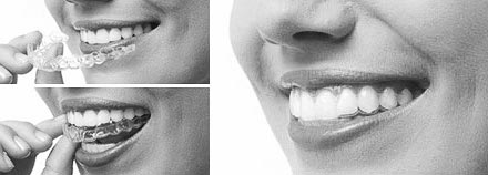 invisalign123_Tandlaege_Tandregulering-bw